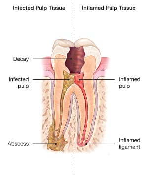 Root canal illustration