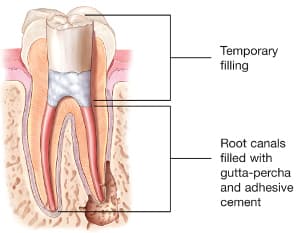 Root canal illustration
