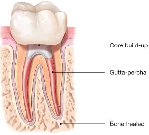Root canal illustration