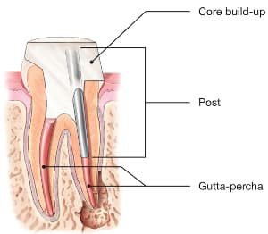 Root canal illustration